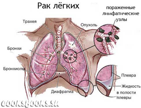 Метастазы в лёгких: симптомы, лечение и прогноз срока жизни для пациентов с разной стадии онкологии и возможные эффективные решения для лечения