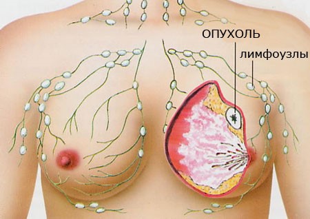 Метастазы при раке молочной железы и куда метастазирует рак груди: прогнозы онкологов, сколько живут пациенты