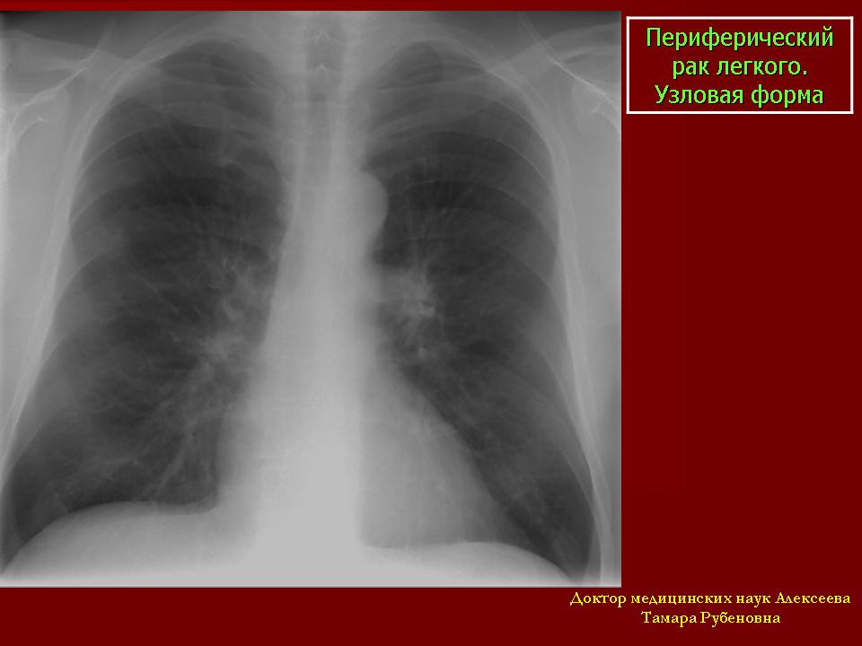 Как выглядит периферический рак легкого на компьютерной томографии
