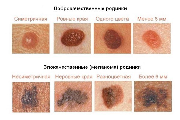 Обследование родинок: подробная инструкция распознавания доброкачественных и злокачественных меланом на коже, делаем визуальный осмотр