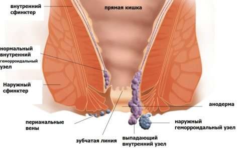 Рак и геморрой: какие отличия двух болезней, как поставить диагноз по симптомам, диагностика и способы профилактики от заболеваний прямой кишки