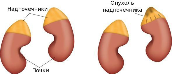 Опухоли надпочечников: что это такое и лечение рака надпочечника, прогноз онкологов на выживание, что говорят врачи о восстановлении