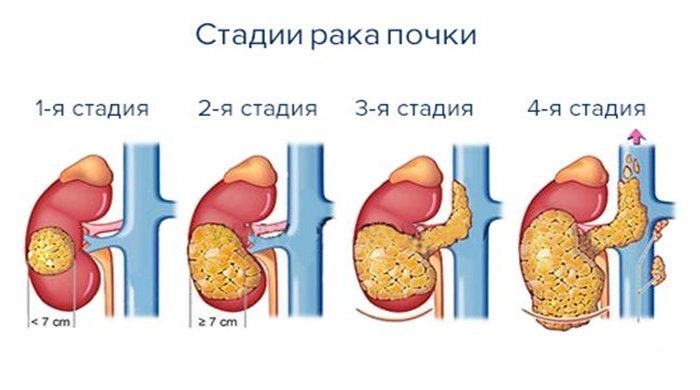 Рак почки: симптомы и признаки, стадии заболевания, код по МКБ 10 и лечение (удаление)