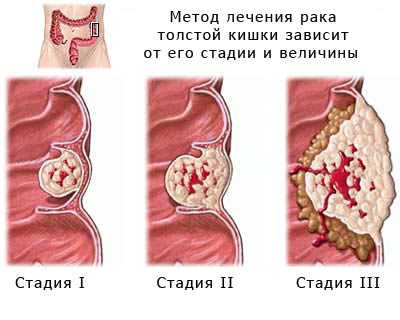 Рак сигмовидной кишки: первые симптомы, особенности лечения, диагностика заболевания и прогноз выживаемости