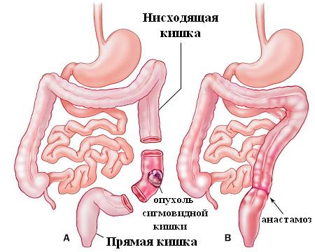 Рак сигмовидной кишки: первые симптомы, особенности лечения, диагностика заболевания и прогноз выживаемости