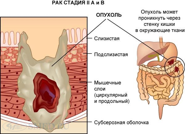 Первые симптомы рака ободочной кишки: особенности лечения, операция, прогноз выживаемости онкологов на выздоровление при разных стадиях