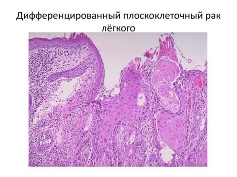 Плоскоклеточный рак: существующие разновидности плоскоклеточного рака, причины возникновения и симптоматика заболевания, виды лечения и возможные осложнения