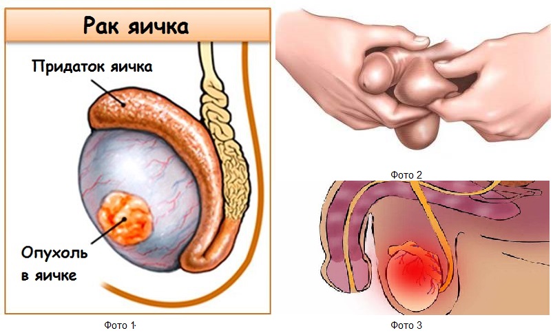 Рак яичка у мужчин: основная информация о заболевании, виды и предрасполагающие к развитию факторы, методы лечения болезни