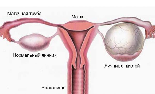 Появление кисты, может ли она перерасти в онкологию: как остановить развитие рака с помощью современной медицины