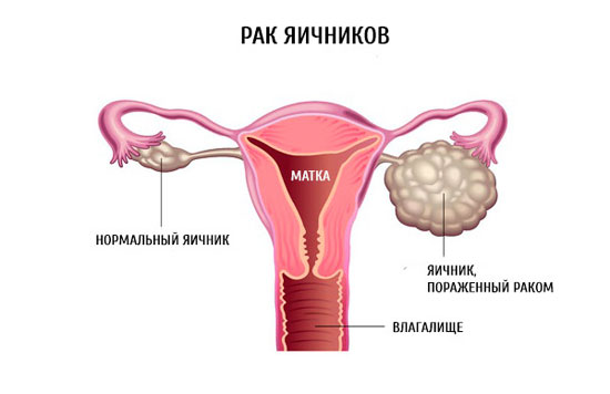 Появление кисты, может ли она перерасти в онкологию: как остановить развитие рака с помощью современной медицины
