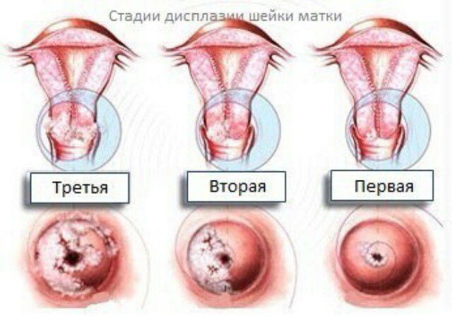 Предраковое состояние шейки матки: заболевания и степени патологических процессов, приводящих к онкологии, анализы и обследование пациентки, виды лечения