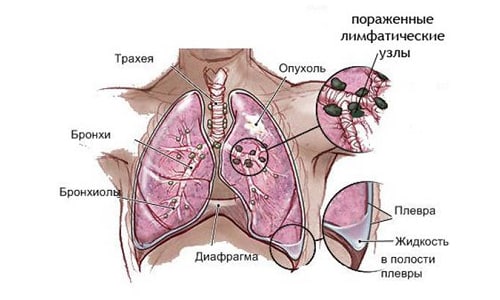 Саркома легких: что это за болезнь, разновидности, причины возникновения и симптомы, методы лечения