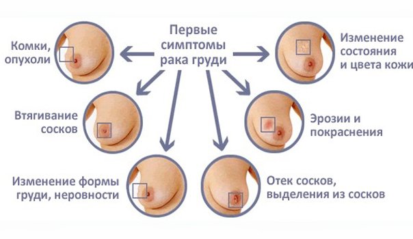 Профилактика рака молочной железы: инструкция для женщин, лечение при первичном обнаружении онкологии и рекомендации онкологов