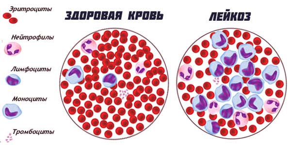 Хронический лейкоз: чем отличается от острого, симптомы заболевания и профилактика, диагностика и методы лечения рака крови