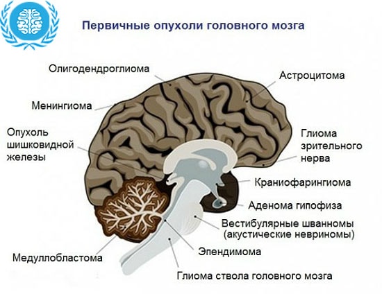 Астроцитома головного мозга: что это такое, методы лечения заболевания, причины формирования опухоли, симптомы мозговых нарушений