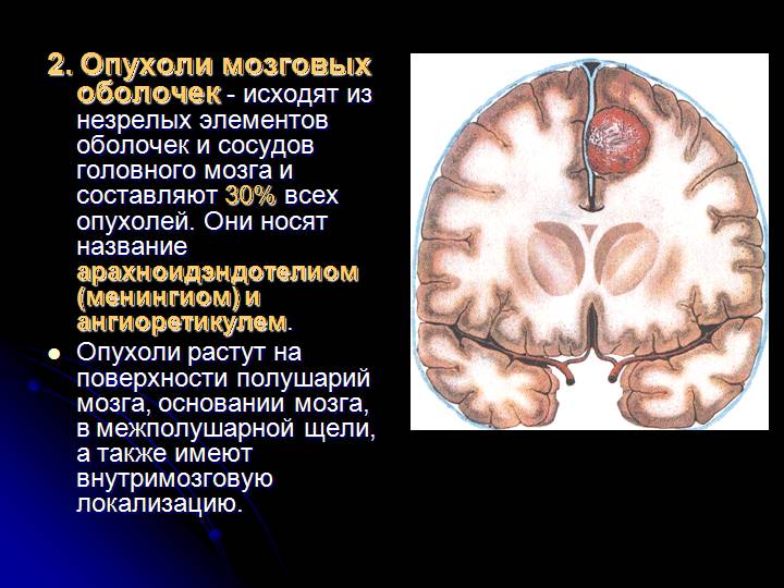 Астроцитома головного мозга: что это такое, методы лечения заболевания, причины формирования опухоли, симптомы мозговых нарушений