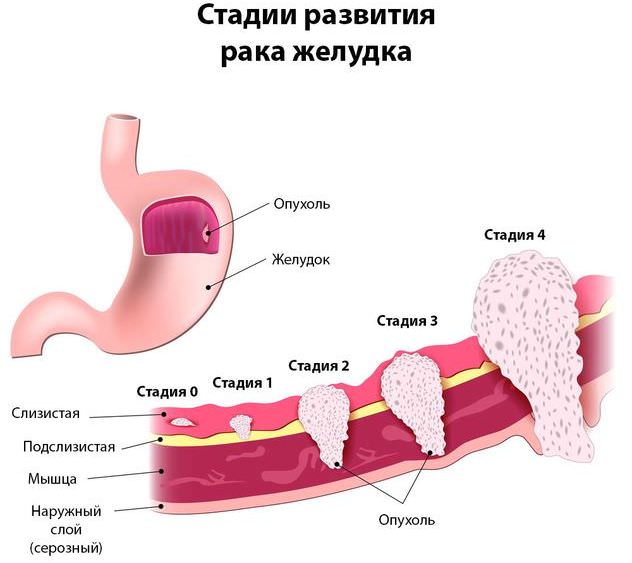 Онкомаркер CA 72-4 : что означает, расшифровка показателей и причины повышеной нормы