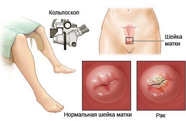 Как профилактика рака шейки матки спасает от болезни: диагностика и лечение болезни на ранней стадии, рекомендации специалистов