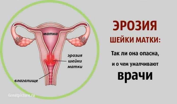 Как профилактика рака шейки матки спасает от болезни: диагностика и лечение болезни на ранней стадии, рекомендации специалистов