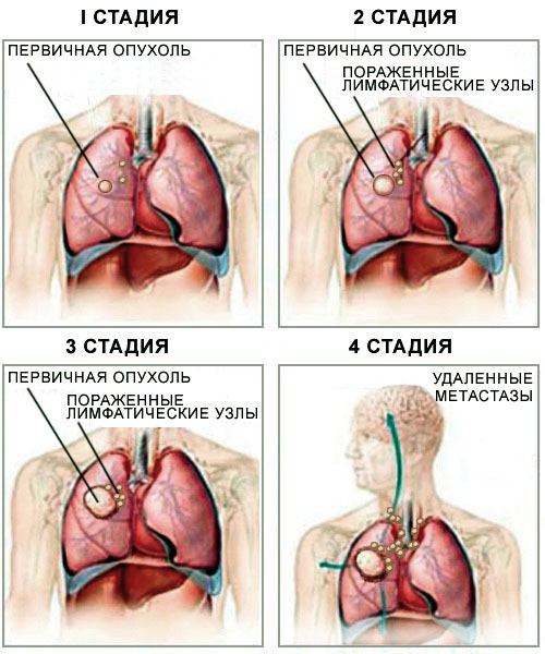 Рак бронхов: что это такое, симптоматика и применяемые виды диагностики, методы лечения, прогнозы онкологов