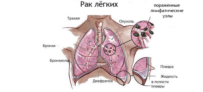 Рак бронхов: что это такое, симптоматика и применяемые виды диагностики, методы лечения, прогнозы онкологов