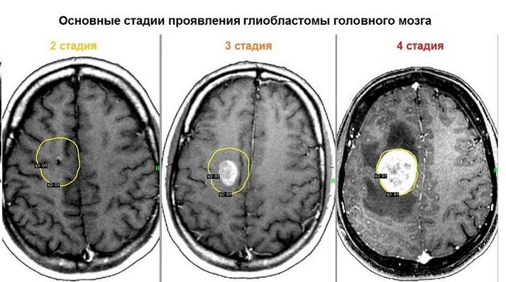 Рак головного мозга 4 степени: классификация и типы опухоли, прогноз выживаемости, возможное лечение