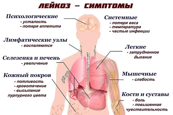 Острый лимфобластный лейкоз у детей: первые симптомы и методы лечения, причины возникновения, прогнозы докторов