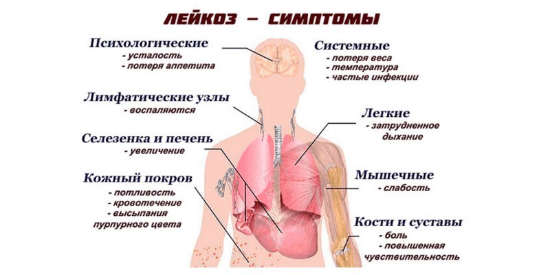 Острый лимфобластный лейкоз у детей: первые симптомы и методы лечения, причины возникновения, прогнозы докторов