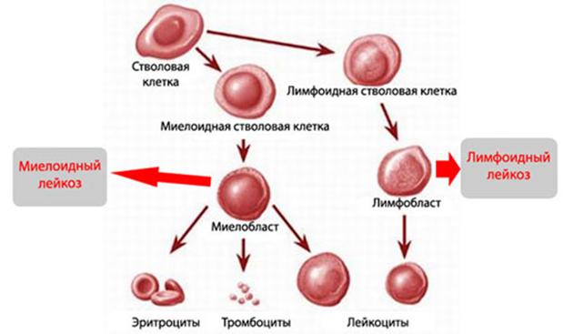Острый лимфобластный лейкоз у детей: первые симптомы и методы лечения, причины возникновения, прогнозы докторов