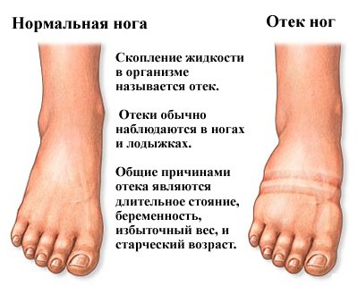 Отек ног при онкологии: механизм образования и провоцирующие факторы, диагностика и лечение болезни Отек ног при онкологии: механизм образования и провоцирующие факторы, диагностика и лечение болезни