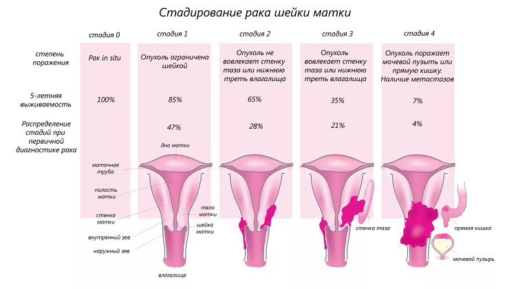 Рак матки: какие первые симптомы, диагностика и лечение, какие дают прогнозы онкологи на различных стадиях