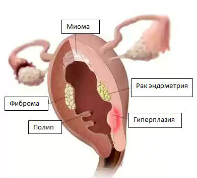 Рак матки: какие первые симптомы, диагностика и лечение, какие дают прогнозы онкологи на различных стадиях