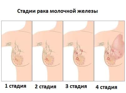 Рак молочной железы 3 стадии: диагностика и выживаемость, как происходит лечении, особенности восстановления