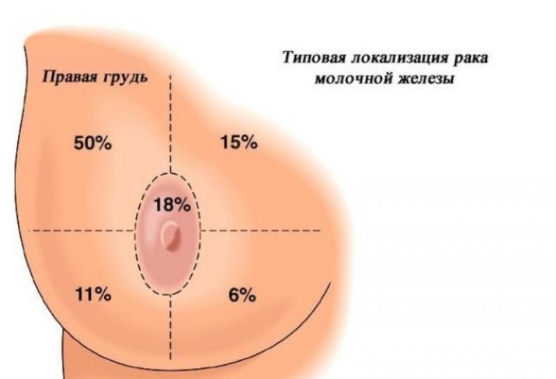 Рак молочной железы 3 стадии: диагностика и выживаемость, как происходит лечении, особенности восстановления