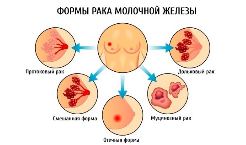 Рак молочной железы 3 стадии: диагностика и выживаемость, как происходит лечении, особенности восстановления