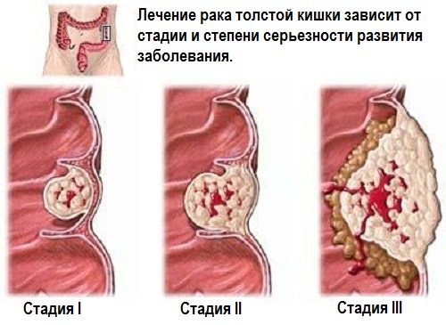 Рак прямой кишки: первые симптомы и признаки развития заболевания, современная диагностика и методы лечения онкологии