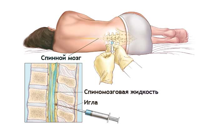 Рак спинного мозга: симптомы и признаки заболевания, диагностика, методы лечения и долгосточный прогноз