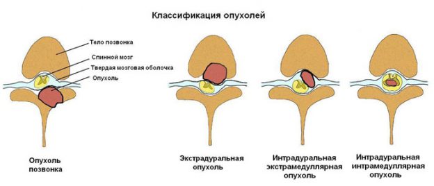 Рак спинного мозга: симптомы и признаки заболевания, диагностика, методы лечения и долгосточный прогноз