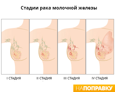 Все про рак груди у женщин: причины заболевания, анализы и исследования, стадии и лечение Все про рак груди у женщин: причины заболевания, анализы и исследования, стадии и лечение