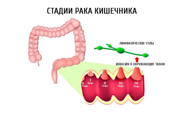 Рак кишечника 4 стадии: симптоматика и проявление болезни, особенности развития опухоли, прогноз выживаемости