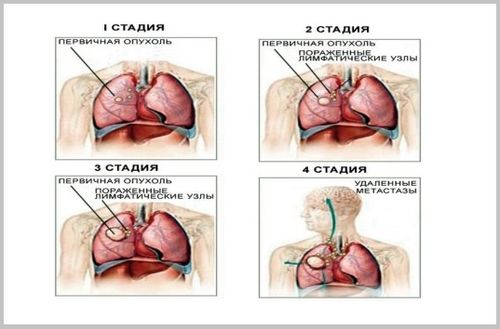 Сколько живут с раком легких на разных стадиях: прогнозы докторов на выживание, что говорят профессиональные онкологи