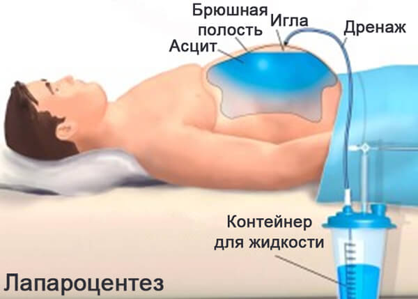 Что такое канцероматоз брюшной полости, прогноз жизни и сколько живут при 4 степени: причина возникновения и оптимальные решения