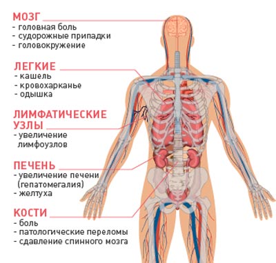 Что такое метастазы при раке: причины распространения, диагностика заболевания и методы проведения лечения