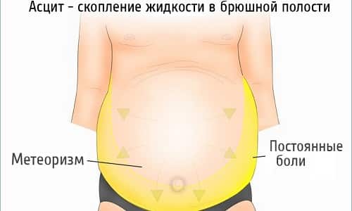 Асцит брюшной полости при онкологии: что это такое, симптомы патологии, стадии и диагностика заболевания, осложнения и выживаемость