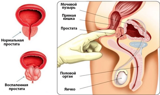 Эскузан при простатите: отзывы, инструкция, показания и противопоказания