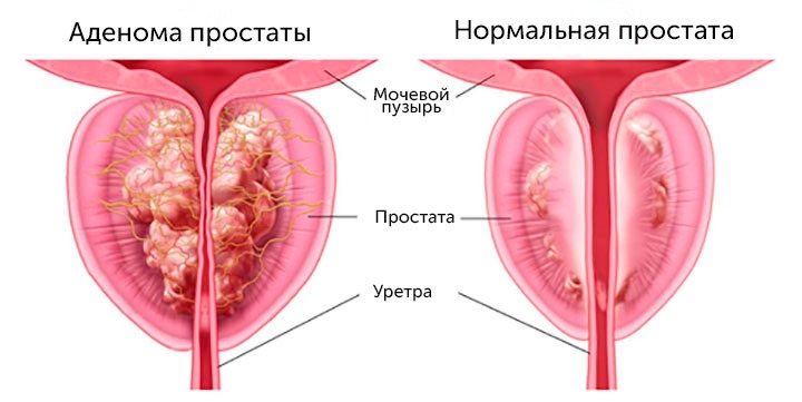 Доксициклин при простатите: отзывы, как принимать, схема приема