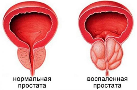 Артезин для лечения простатита: отзывы, применение, противопоказания, побочные эффекты