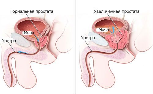 Свечи от аденомы простаты (предстательной железы)