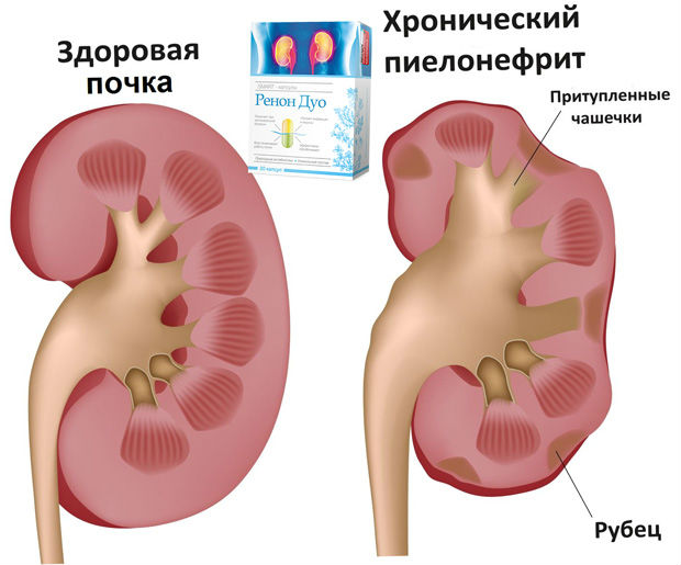 Ренон Дуо: отзывы, цена средства для восстановления почек, инструкция