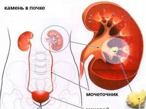 Виды камней в почках, их фото и описание, как определить состав камня